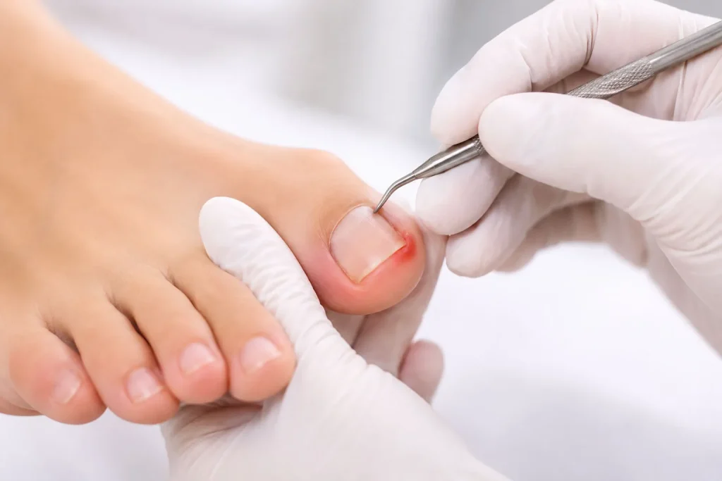 Tratament unghie încarnată Iași – consultație podologică la cabinetul Podo Nails